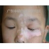 广东中研白癜风研究院：哪些方法治疗婴儿出现的白癜风病