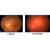 武汉黄斑病变有哪些症状？艾格眼科专家说出现视力模糊需要警惕