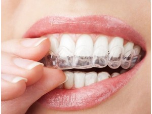 上海牙科机构：传统矫正和隐形矫正哪种好？