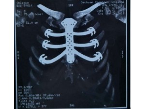 重庆长城医院完成一例人工胸骨假体外露伴感染病人